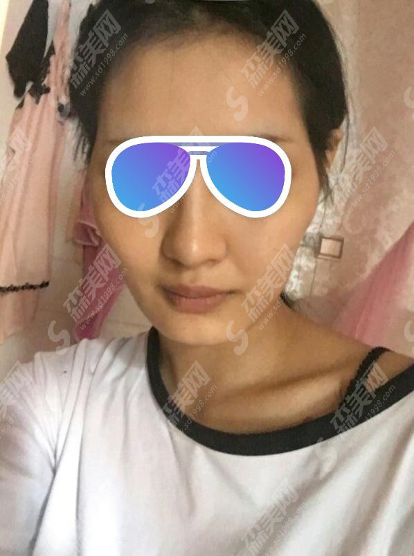 自体脂肪面部填充价格怎么样?自体脂肪面部填充价格一栏及自体脂肪面部填充成功案例分享