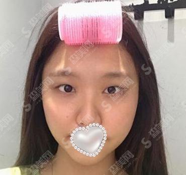 西京医院做的双眼皮果好不好?附西京医院介绍以及孙峰医生介绍&2021双眼皮手术价格一览&双眼皮手术整形