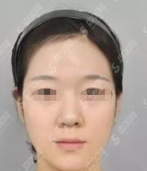整形专家李发成怎么样？李成发做的整形果哟怎么样？附医院介绍及案例分享