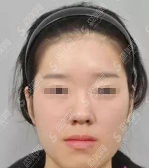 整形专家李发成怎么样？李成发做的整形果哟怎么样？附医院介绍及案例分享