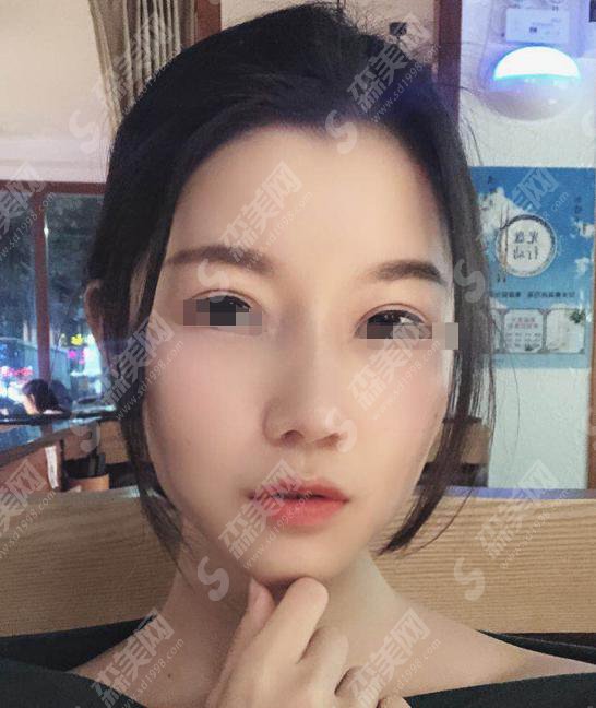 整形专家彭喆怎么样?彭喆医师做的隆鼻果怎么样?附医院介绍及彭喆医师案例分享