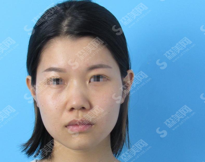 整形专家彭喆怎么样?彭喆医师做的隆鼻果怎么样?附医院介绍及彭喆医师案例分享