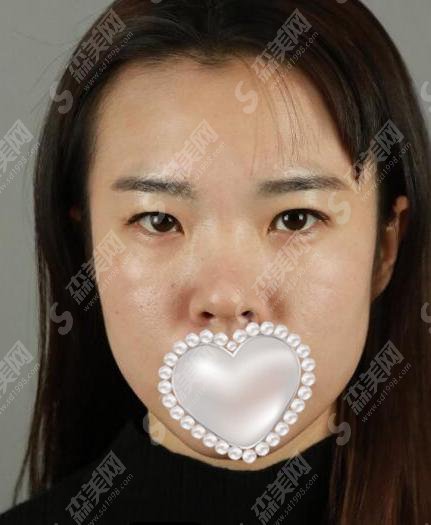 西京医院双眼皮果好不好?附西京医院介绍以及易成刚医生介绍&双眼皮手术案例分享