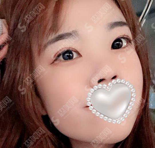 西京医院双眼皮果好不好?附西京医院介绍以及易成刚医生介绍&双眼皮手术案例分享