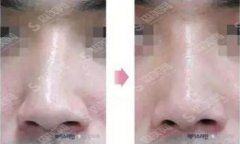 歪鼻整形的价格？歪鼻矫正的果如何？