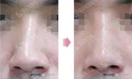 歪鼻整形的价格?歪鼻矫正的果如何?