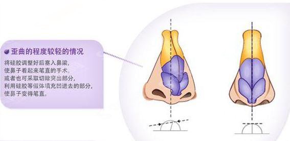 歪鼻整形的价格?歪鼻矫正的果如何?