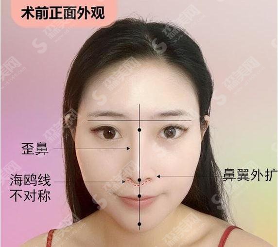 歪鼻整形的价格?歪鼻矫正的果如何?