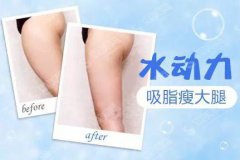 水动力吸脂的价格?水动力吸脂原理以及优势?