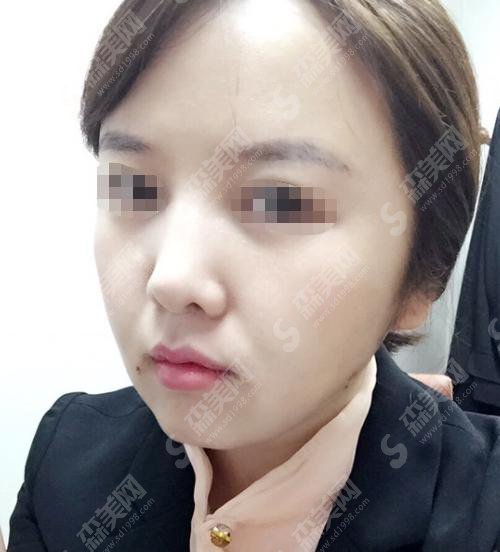 整形专家王淑杰怎么样？王淑杰医师做的隆鼻怎么样？附医院介绍及医生案例