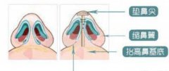 鼻部整形需要多少钱？附硅胶隆鼻案例+前后果对比图