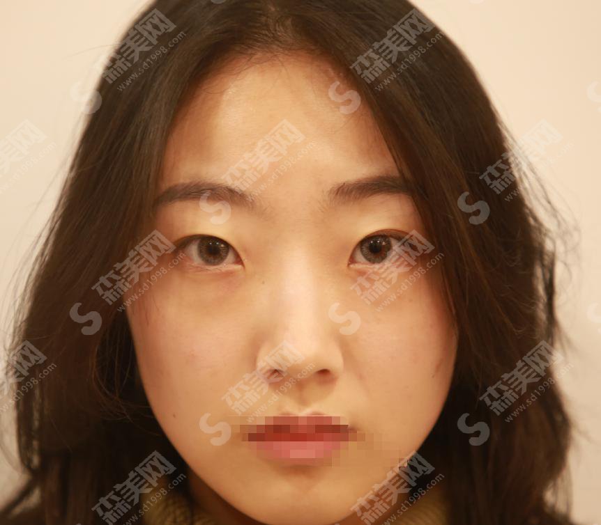整形专家胡晓根怎么样？胡晓根做的双眼皮果好不好附医院介绍及案例分享