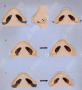 缩小鼻翼多少钱？附缩小鼻翼案例+前后果对比图