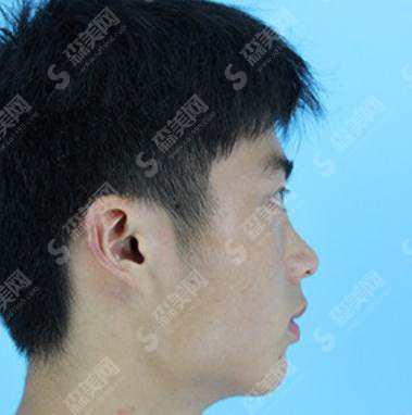 韦敏医生隆鼻专业吗？南昌美伊尔医疗美容门诊部/个人简介/隆鼻案例