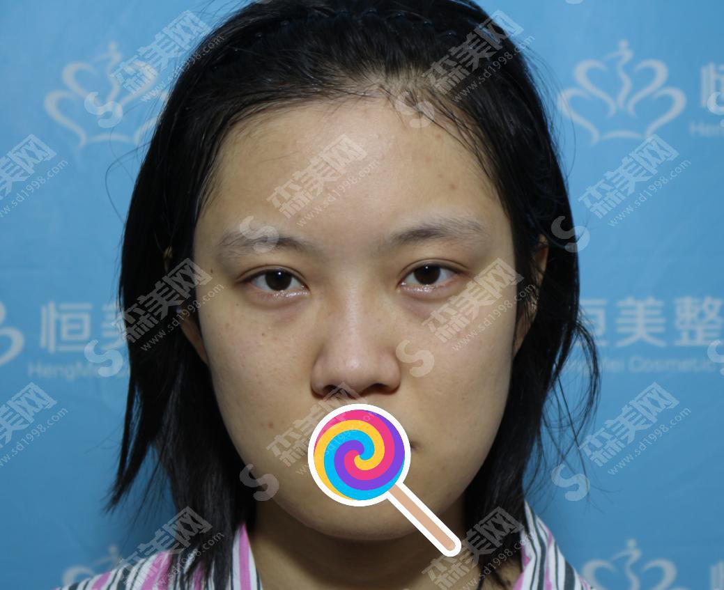 膨体隆鼻价格多少？附膨体隆鼻价格一栏及膨体隆鼻手术成功案例分享