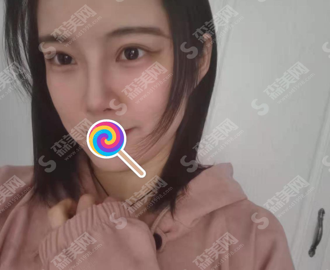 膨体隆鼻价格多少？附膨体隆鼻价格一栏及膨体隆鼻手术成功案例分享