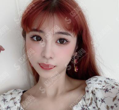 内含仁济医院的介绍,皮庆猛医生开眼角真实案例分享