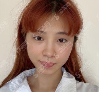 内含仁济医院的介绍,皮庆猛医生开眼角真实案例分享