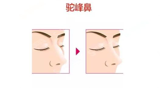 驼峰鼻矫正要多少钱?驼峰鼻矫正果怎么样?附驼峰鼻介绍及驼峰鼻矫正案例