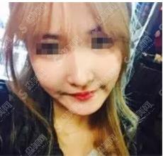 驼峰鼻矫正要多少钱?驼峰鼻矫正果怎么样?附驼峰鼻介绍及驼峰鼻矫正案例