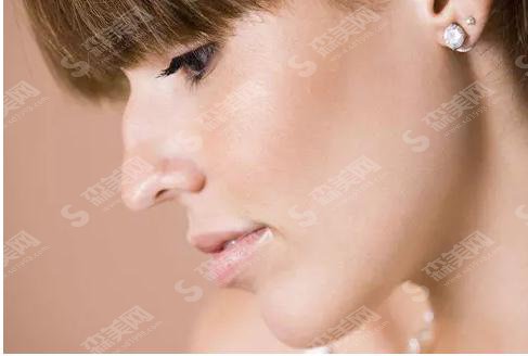 驼峰鼻矫正要多少钱?驼峰鼻矫正果怎么样?附驼峰鼻介绍及驼峰鼻矫正案例