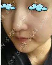 驼峰鼻矫正要多少钱?驼峰鼻矫正果怎么样?附驼峰鼻介绍及驼峰鼻矫正案例