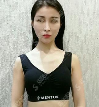 内含上海九院的介绍,闵沛如医生假体隆胸案例分享