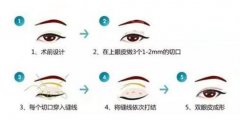 埋线双眼皮的价格是多少？附埋线双眼皮价格一栏及埋线双眼皮手术成功案例