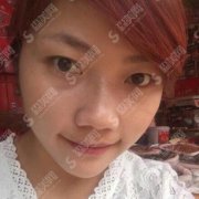 黑脸娃娃的治疗方法价目表2020,黑脸娃娃的治疗果怎么样?内附黑脸娃娃的治疗过程对比图