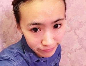 面部皮肤治疗价目表2020黑脸娃娃果怎么样?内附黑脸娃娃的治疗案例果对比图