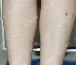 武汉激光脱毛价目表2021,激光脱毛果怎么样?内附激光脱毛项目较新价目表