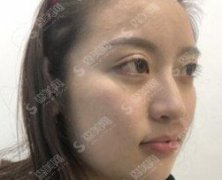 注射注射瘦脸的价目表2020,注射瘦脸和玻尿酸同时进行塑形的果怎么样？内附注射整形的康复对比图