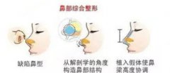 鼻部综合整形的价格是多少钱?附鼻部综合整形价格一栏及鼻部综合整形的成功案例分享