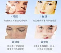 激光治疗黄褐斑的价格？附激光治疗黄褐斑案例+前后果对比图