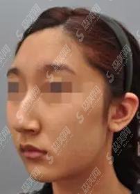 魏娴医生怎么样？魏娴医师做的鼻子矫正怎么样？附医院介绍及医师案例