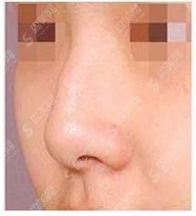 驼峰鼻矫正价格是多少?驼峰鼻矫正 果好不好?附驼峰鼻介绍及案例分享