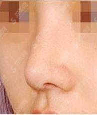 驼峰鼻矫正价格是多少?驼峰鼻矫正 果好不好?附驼峰鼻介绍及案例分享