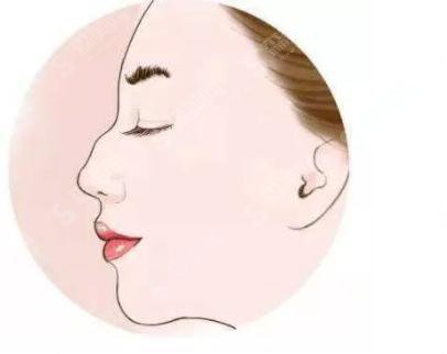 驼峰鼻矫正价格是多少?驼峰鼻矫正 果好不好?附驼峰鼻介绍及案例分享