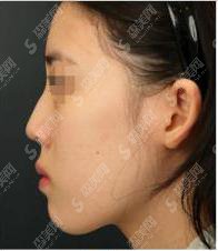 驼峰鼻矫正多少钱?驼峰鼻矫正果好不好?附驼峰鼻介绍及案例分享