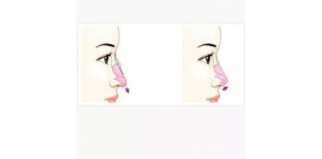 驼峰鼻矫正多少钱?驼峰鼻矫正果好不好?附驼峰鼻介绍及案例分享