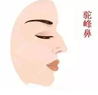驼峰鼻矫正多少钱?驼峰鼻矫正果好不好?附驼峰鼻介绍及案例分享