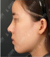 驼峰鼻矫正多少钱?驼峰鼻矫正果好不好?附驼峰鼻介绍及案例分享