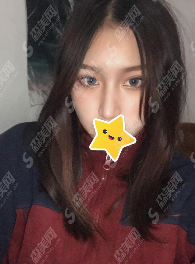 驼峰鼻矫正需要花费多少钱?附驼峰鼻矫正费用一栏及驼峰鼻矫正成功案例分享