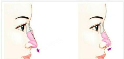 驼峰鼻矫正需要花费多少钱?附驼峰鼻矫正费用一栏及驼峰鼻矫正成功案例分享