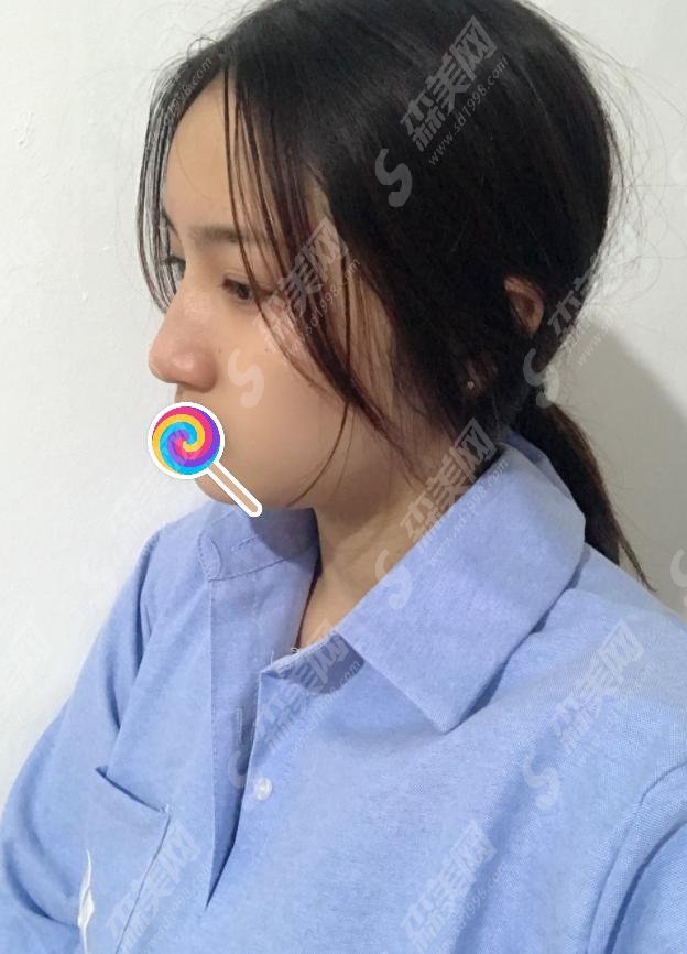 驼峰鼻矫正需要花费多少钱?附驼峰鼻矫正费用一栏及驼峰鼻矫正成功案例分享