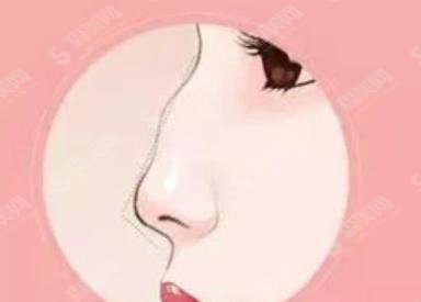 驼峰鼻矫正多少钱?驼峰鼻矫正果好不好?附驼峰鼻介绍及案例分享
