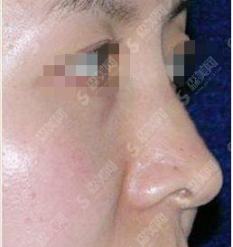 驼峰鼻矫正多少钱?驼峰鼻矫正果好不好?附驼峰鼻介绍及案例分享