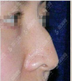 驼峰鼻矫正多少钱?驼峰鼻矫正果好不好?附驼峰鼻介绍及案例分享