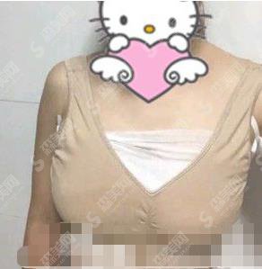 上海九院价目表2021，内含徐华医生自体脂肪隆胸案例果图