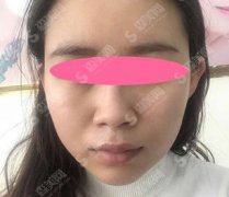 注射瘦脸注射价目表2020,注射瘦脸的注射果怎么样？内附注射注射瘦脸的恢复过程图